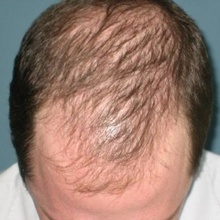 ¿Qué es la alopecia androgenica?